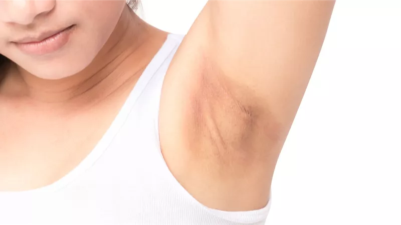 6 وصفات طبيعية تخلصك من اسمرار الإبط نهائيا