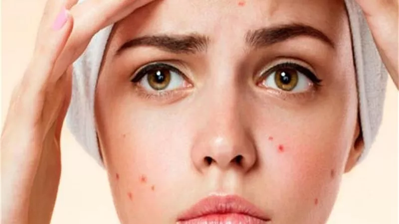  4 وصفات طبيعية تخلصك من حب الشباب نهائيًا