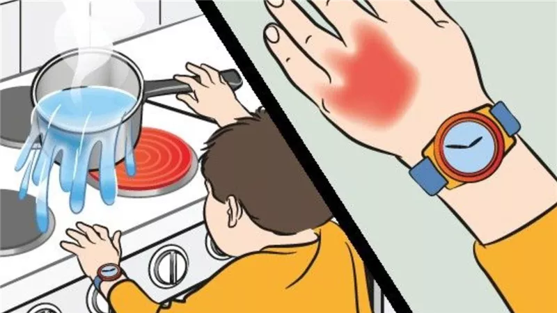 5 إسعافات أولية لمعالجة حروق الأطفال داخل المنزل «العسل والخردل»
