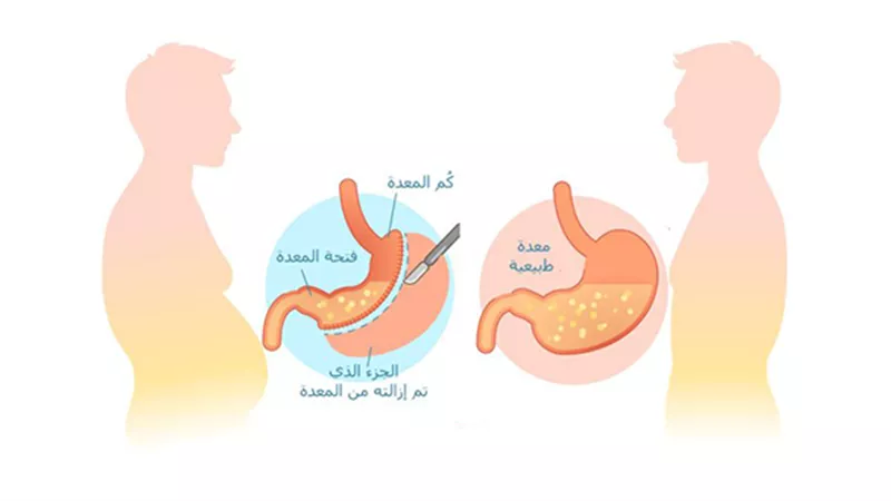 مخاطر عملية تكميم المعدة «هل تؤدي إلى الوفاة؟»