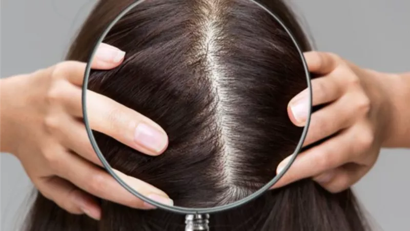 3 أسباب لرائحة فروة الرأس الكريهة وطرق العلاج 
