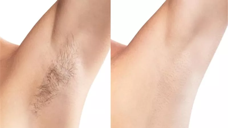 وصفة لإزالة الشعر من الوجه والجسم في دقائق دون ألم