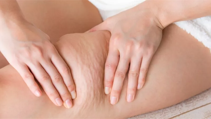 طرق طبيعية تخلصك من السيلوليت نهائيًا