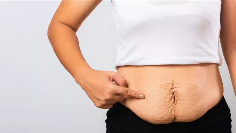 4 خطوات سهلة تخلصك من ترهلات البطن بعد الولادة القيصرية 