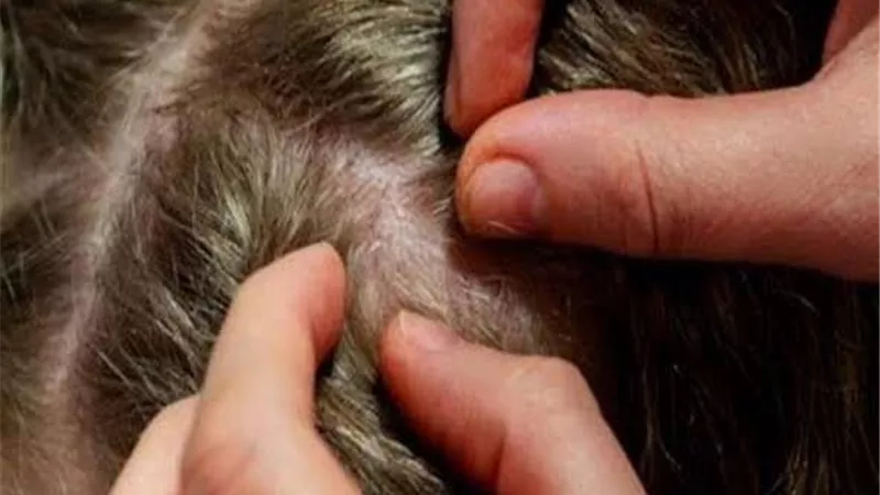 3 طرق طبيعية للتخلص من القمل