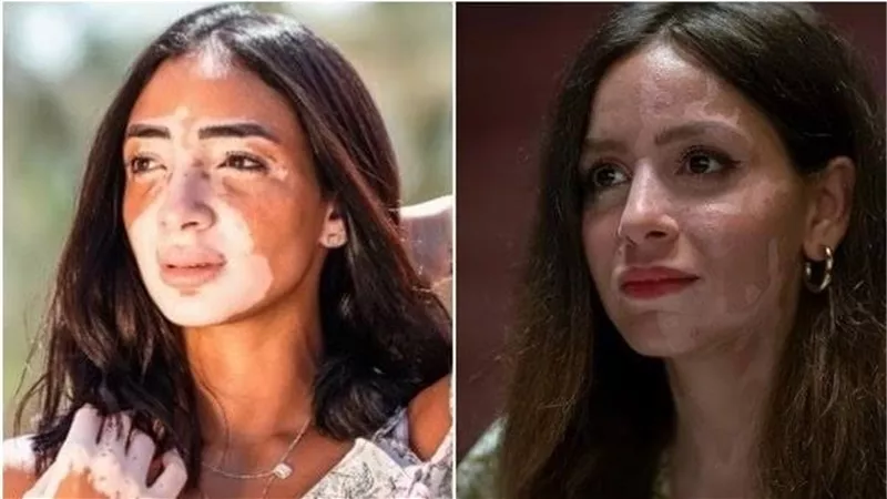3 أسباب لمرض البهاق وطرق العلاج 