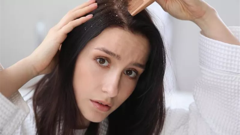 11 وصفة طبيعية لعلاج قشرة الشعر
