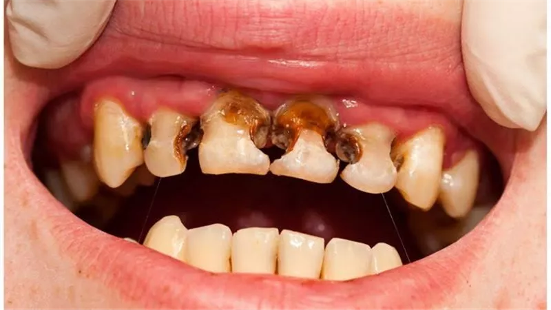 3 أعراض لتأثير مرض السكري على الأسنان 