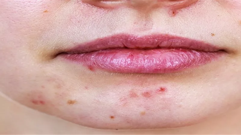 6 ممارسات خاطئة تعرضك لظهور بثور وحبوب الوجه 