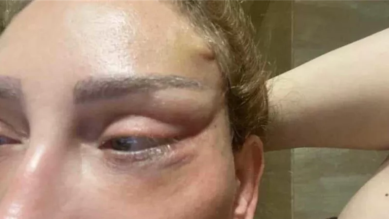 3 أضرار لعمليات التجميل بعد تشوه وجه ريهام سعيد