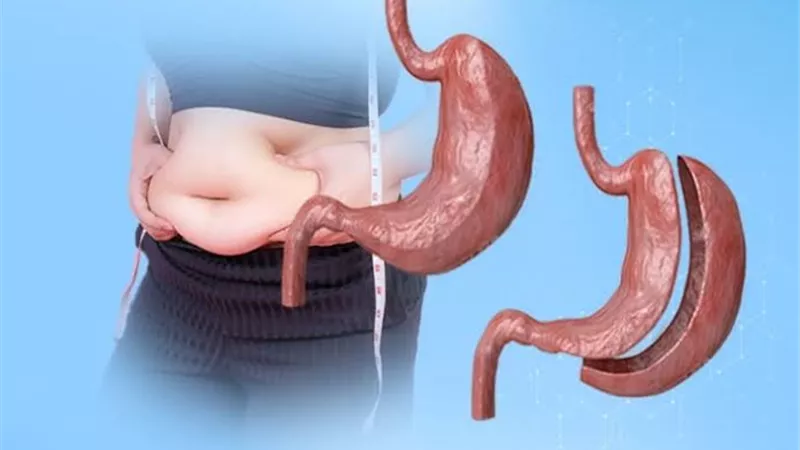 5 أعراض جانبية بعد إجراء تكميم المعدة.. اكتشفيها 