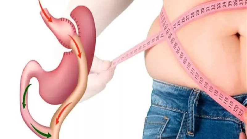 8 مخاطر لعملية تكميم المعدة الجراحية