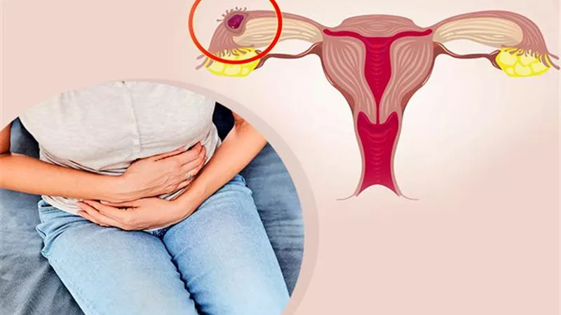 5 عوامل تؤدي لحدوث الحمل خارج الرحم