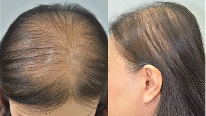 5 أسباب تؤدي إلى إصابة المرأة بالصلع